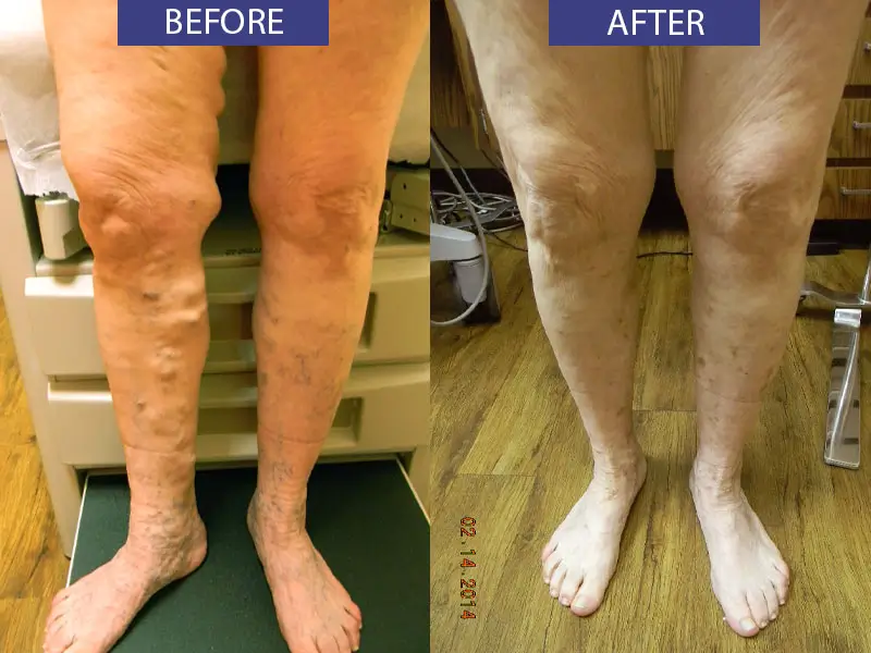 Before and after spider vein leg treatment.