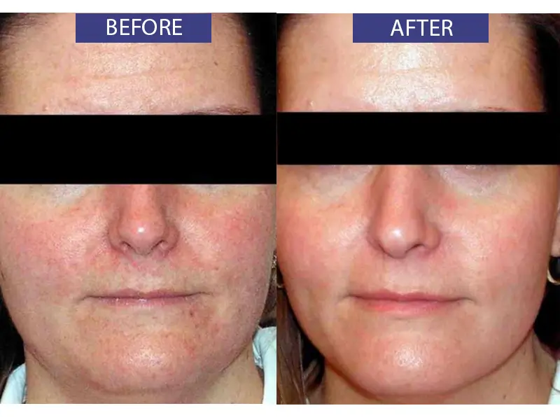 Before and after facial redness reduction treatment.