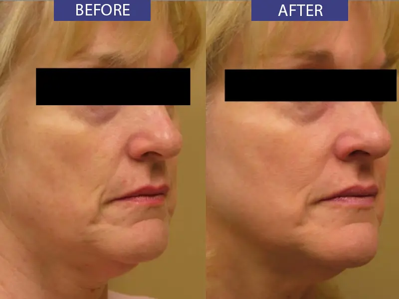 Before and after facial tightening treatment result.