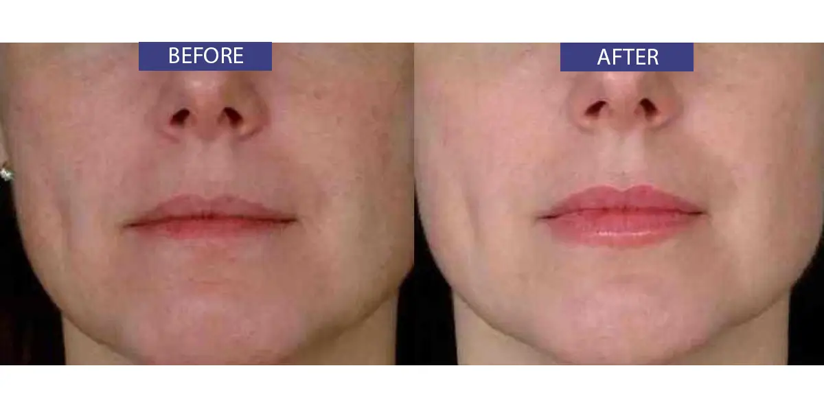 Before and after image of facial treatment.