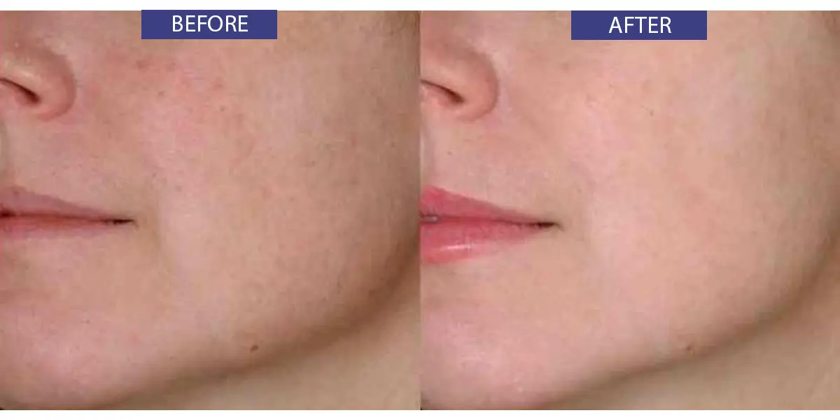 Before and after photo of facial rejuvenation.