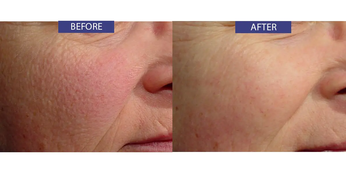Before and after facial skin treatment.