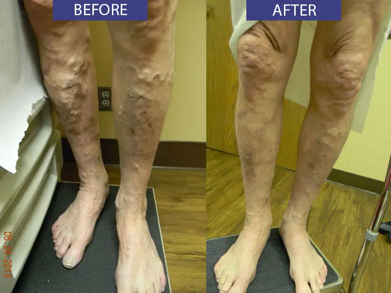 Before and after varicose veins leg treatment.