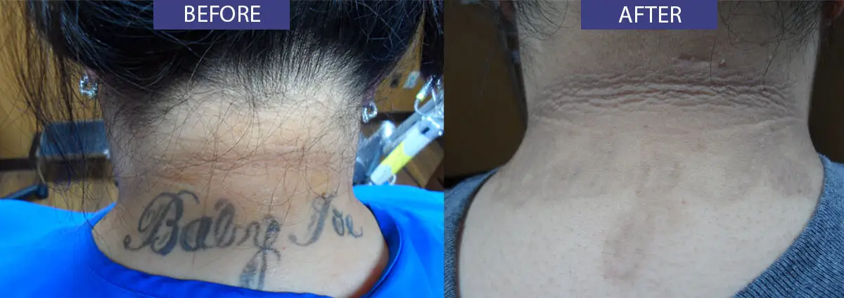 Before and after neck tattoo removal treatment.