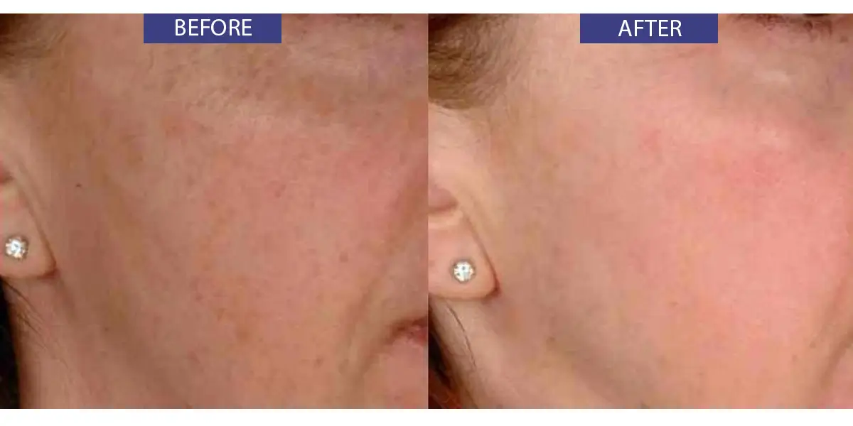 Before and after sunspot skin treatment.