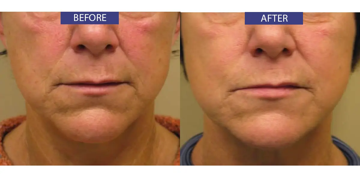 Before and after lower face rejuvenation treatment.