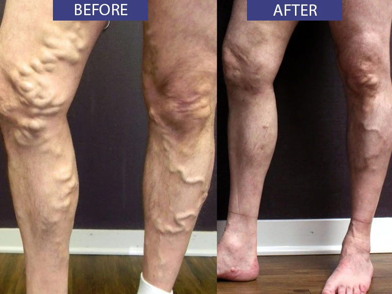 Before and after varicose vein treatment results.