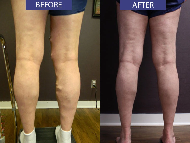 Before and after 2