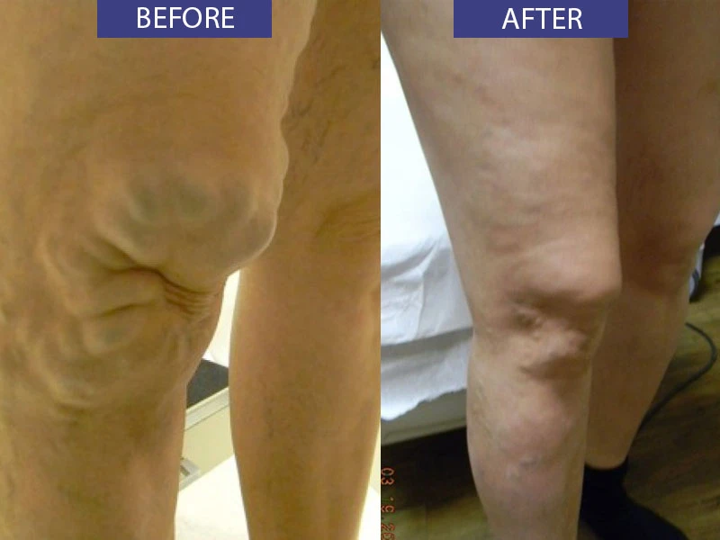 Before and after