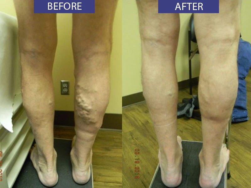 Before and after varicose vein leg treatment.